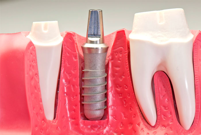 Технологии здравоохранения, стандарты зубных имплантатов